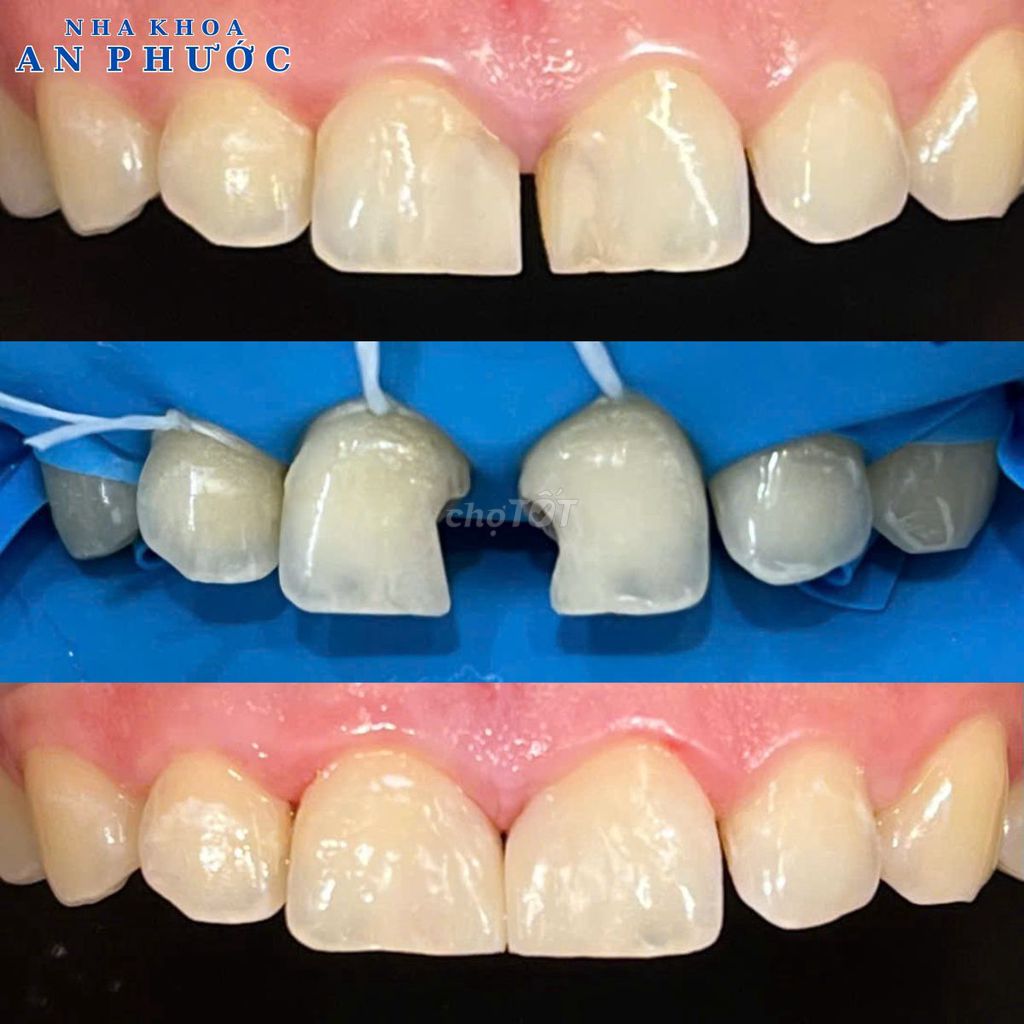 Trám răng thẩm mỹ Nha Khoa An Phước. Dịch vụ tại Huyện Duy Xuyên Quảng Nam được đăng bởi Nha Khoa An Phước hình 1