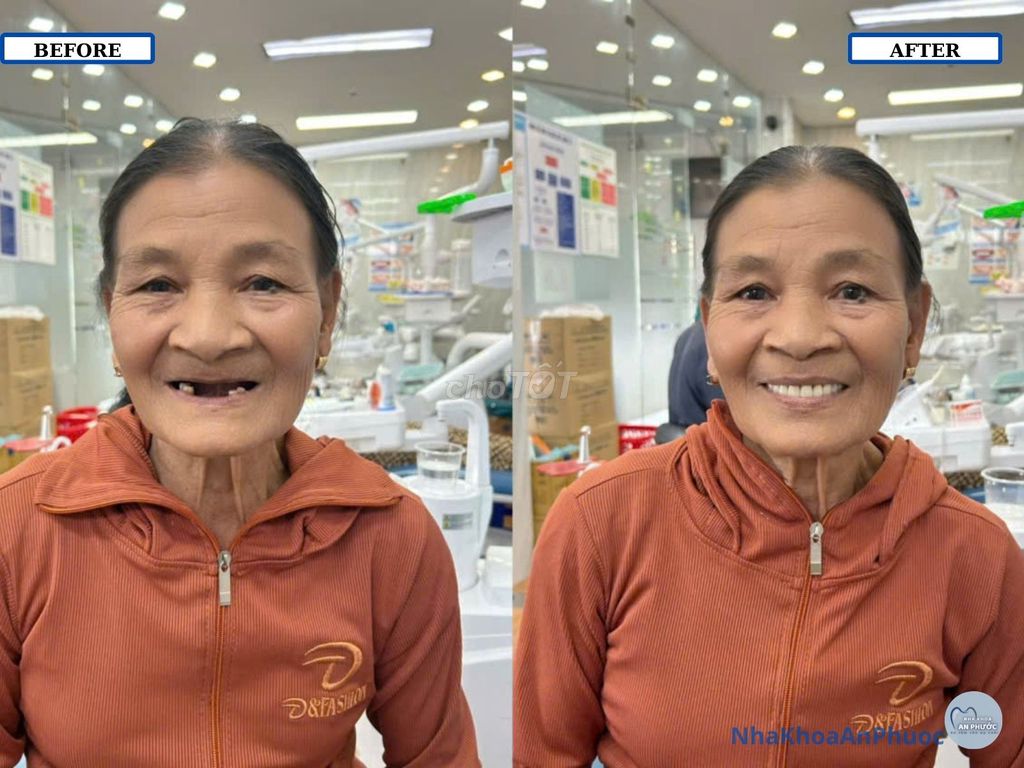 Dịch vụ Phục Hình Răng Giả Tháo Lắp. Dịch vụ tại Huyện Duy Xuyên Quảng Nam được đăng bởi Nha Khoa An Phước hình 1